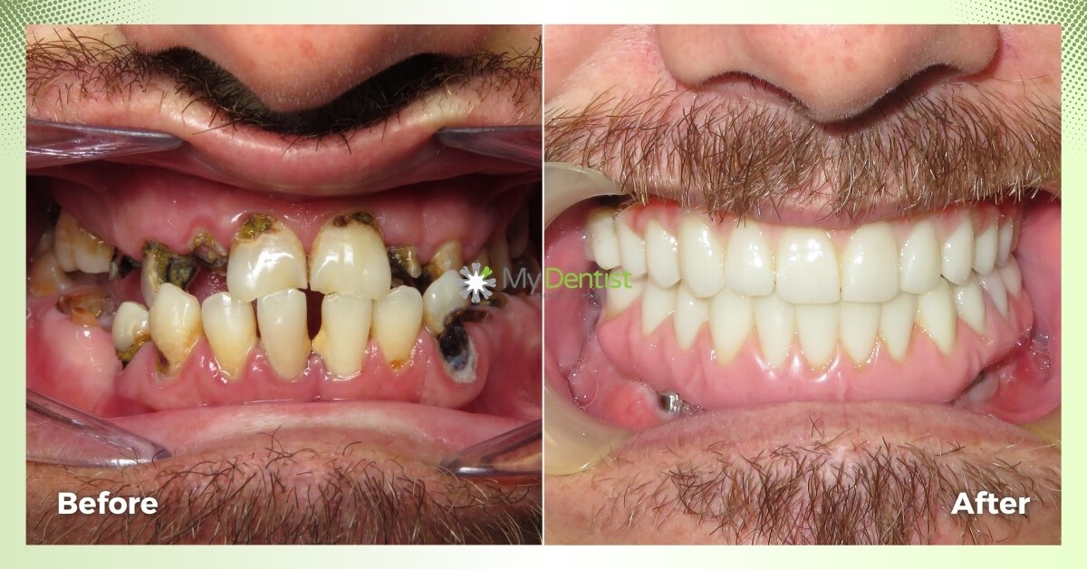 Jason-Smile-Makeover_Alderley_My-Dentist_Before-and-After-Images-1