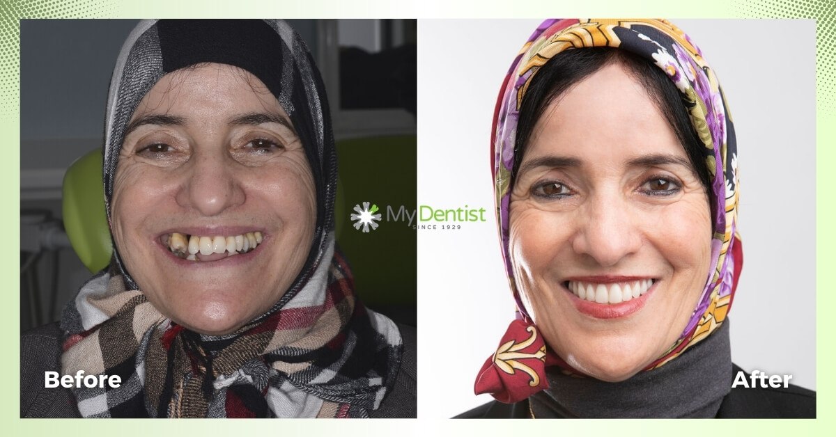 Mina-Smile-Makeover_My-Dentist_Alderley_Before-and-After-Images