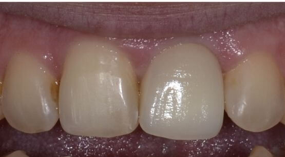Dental Implants Treatment - My Dentist