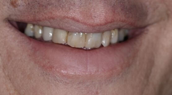 Dental Implants Treatment - My Dentist