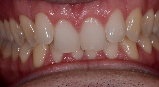 Orthodontic Treatment - My Dentist