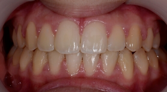 Orthodontics Treatment - My Dentist
