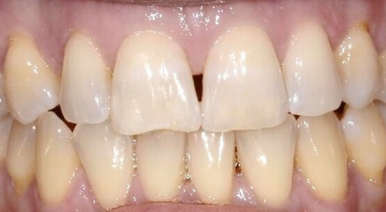 Orthodontic Treatment - My Dentist