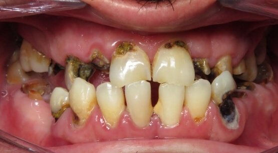 All-On-4 Treatment - My Dentist