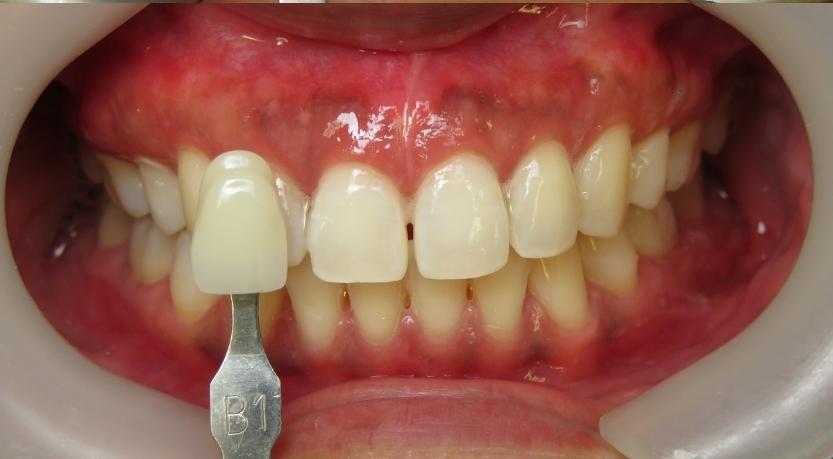 Teeth Whitening Treatment - My Dentist