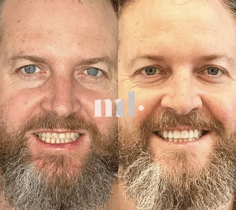 Treatment: Dental Veneers Time Taken After Procedure: 6 Weeks