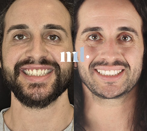 Treatment: Invisalign, Whitening, Composite Build Ups Time Taken After Procedure: 12 Months