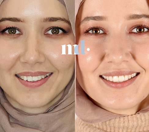Treatment: Invisalign and Whitening Time Taken After Procedure: 10 Months