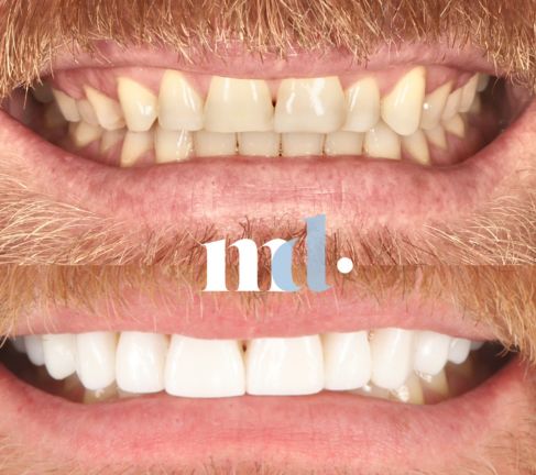 Treatment: Gum Lift Whitening and Composite Veneers Time Taken After Procedure: 3 Months