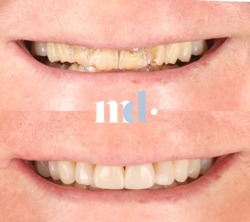 Treatment: Composite Veneers Time Taken After Procedure: 2 Weeks