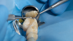 A tooth-coloured composite filling matched to the natural tooth shade at My Dentist Alderley.
