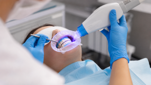 In-chair teeth whitening in progress at My Dentist Alderley with protective gel and a cheek retractor in place.
