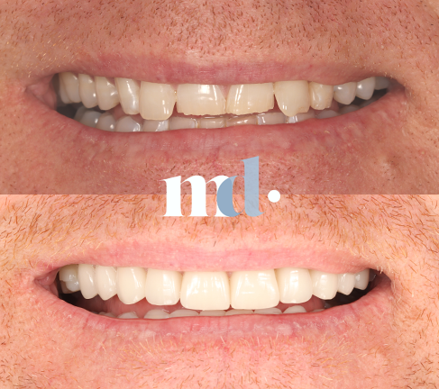 Treatment: Veneers Time Taken After Procedure: 3 Weeks