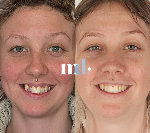 Treatment: Invisalign and Edge Bonding Time Taken After Procedure: 18 Months