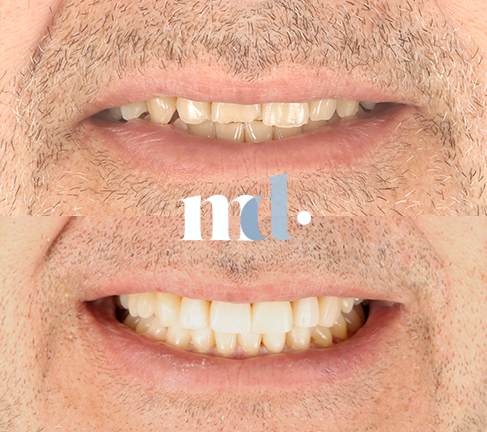 Treatment: Teeth whitening, Composite/Dahl build ups Time Taken After Procedure: 4weeks apart